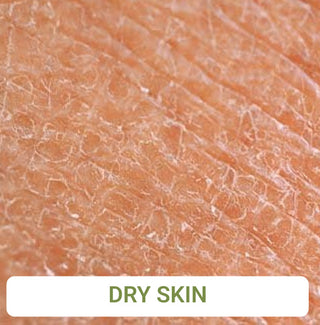 Dry Skin