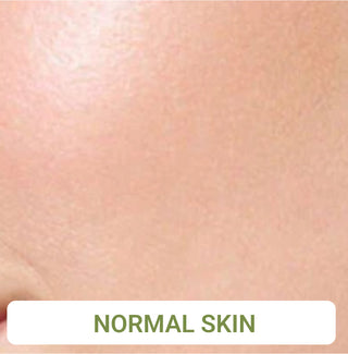 Normal Skin