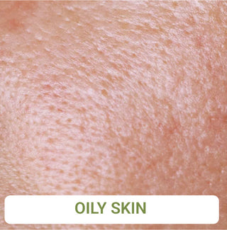 Oily Skin
