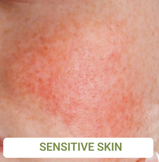 Sensitive Skin